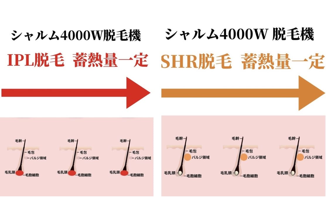 IPL SHRシャルム脱毛機 出力一定