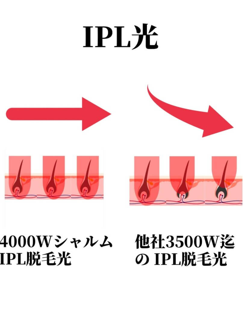 IPL光　図